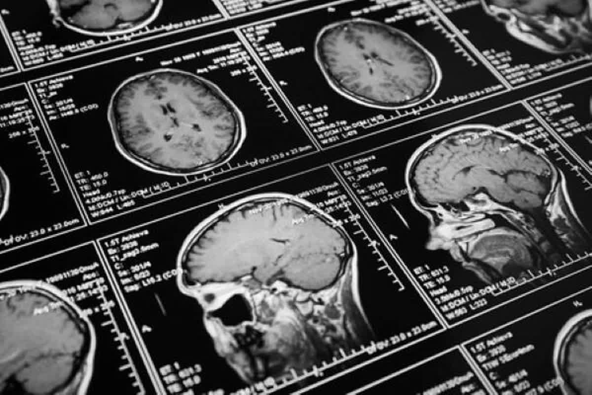 Can MRIs Predict Parkinson's? New Research Says Yes